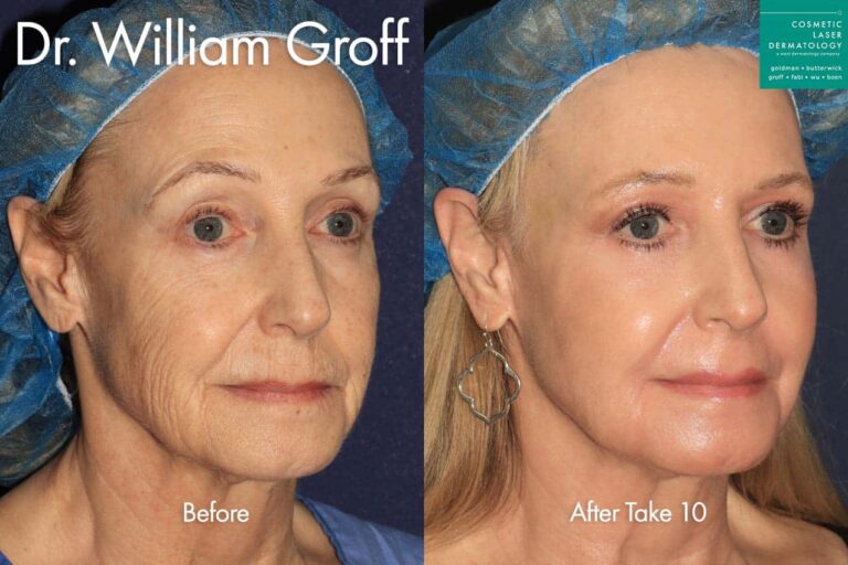 Take 10 for a rejuvenated appearance by Dr. Groff. After treatment, patient looks ten years younger as her wrinkles are much less pronounced if not gone, and her sun damage is gone.