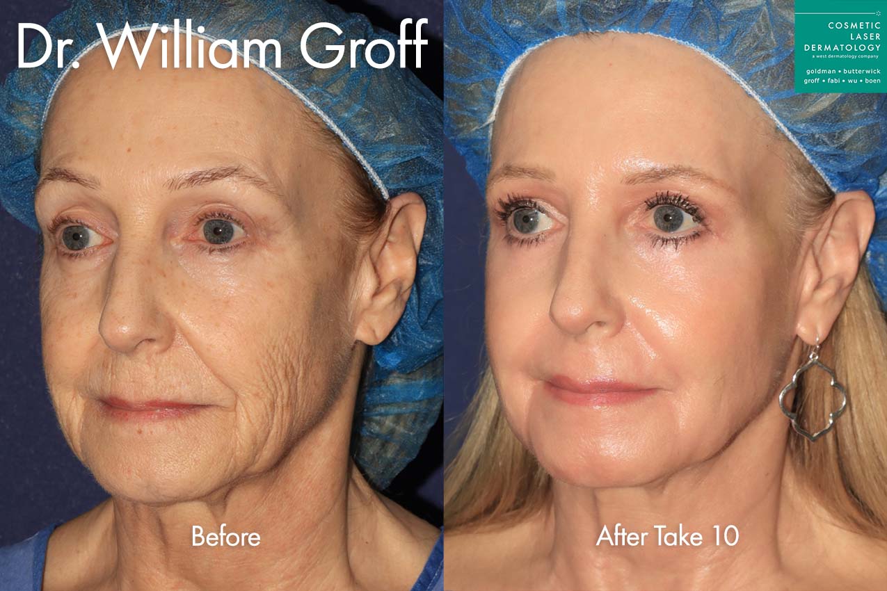 cosmetic laser dermatology take10 before and after san diego ca