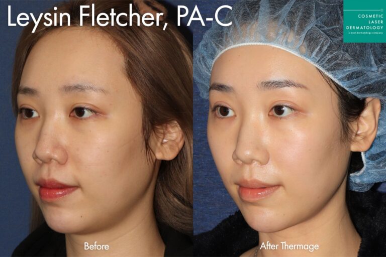 Thermage for skin tightening by Leysin Fletcher, PA-C. After treatment, the patient has an overall more lifted look, especially in the jawline.