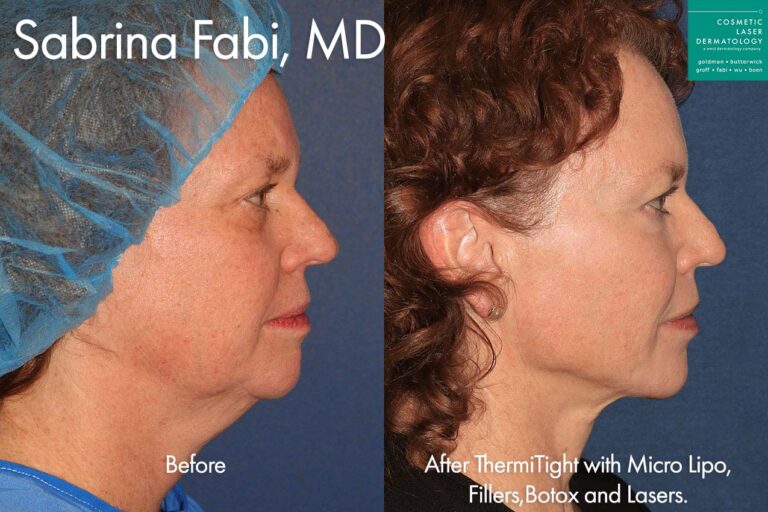ThermiTight with MicroLipo, Filler, Botox, and Lasers for total rejuvenation by Dr. Fabi. After treatment, the patient is totally rejuvenated: her skin tone is much more even, her submental fat is reduced, and her face appears more feminine overall.