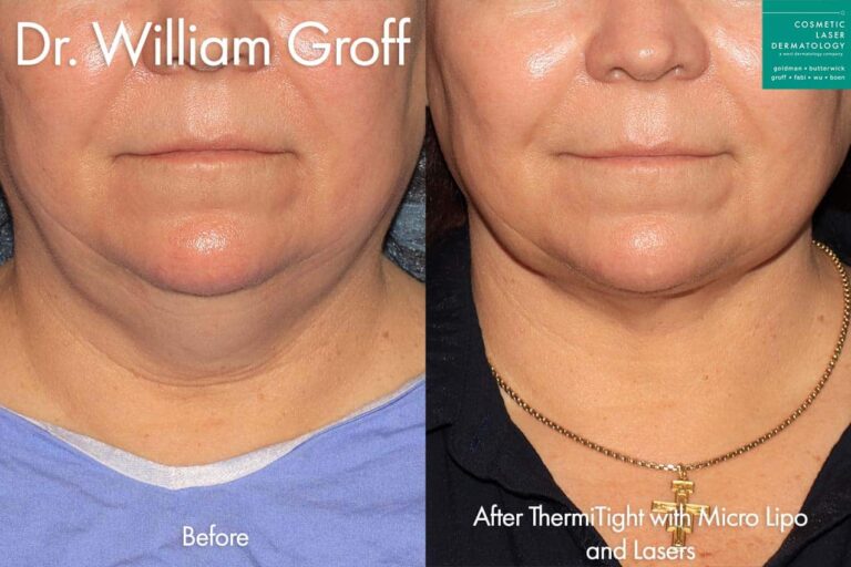 ThermiTight with MicroLipo and Lasers to enhance the chin, jawline, and neck by Dr. Groff. After treatment, the patient's excess fat is gone and the skin tone is much more even.