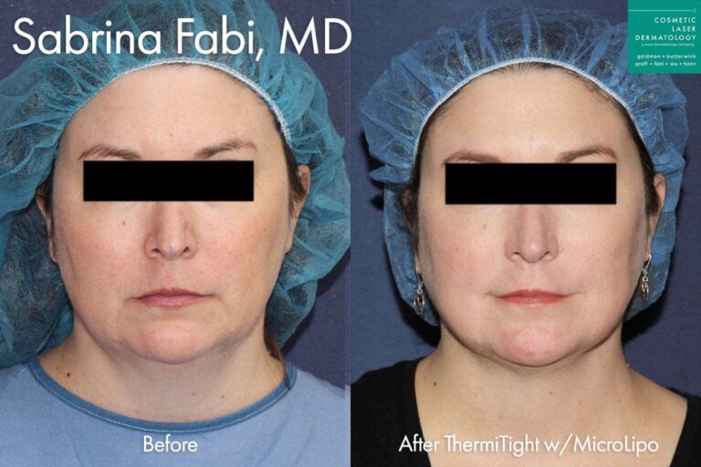 ThermiTight with MicroLipo for submental fat reduction by Dr. Fabi. After treatment, the patient's submental fat is significantly reduced.