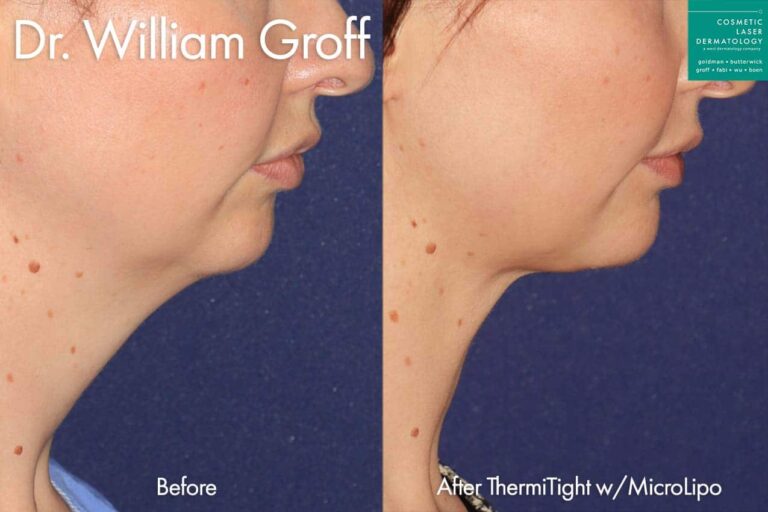 ThermiTight with MicroLipo to contour the neck and chin by Dr. Groff. After treatment, the patient's submental fat is greatly reduced.