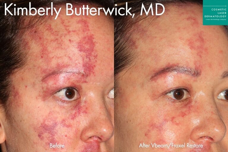 Vbeam and Fraxel Restore to treat port wine stain by Dr. Butterwick. After treatment, the patient's port wine stain has been significantly reduced.