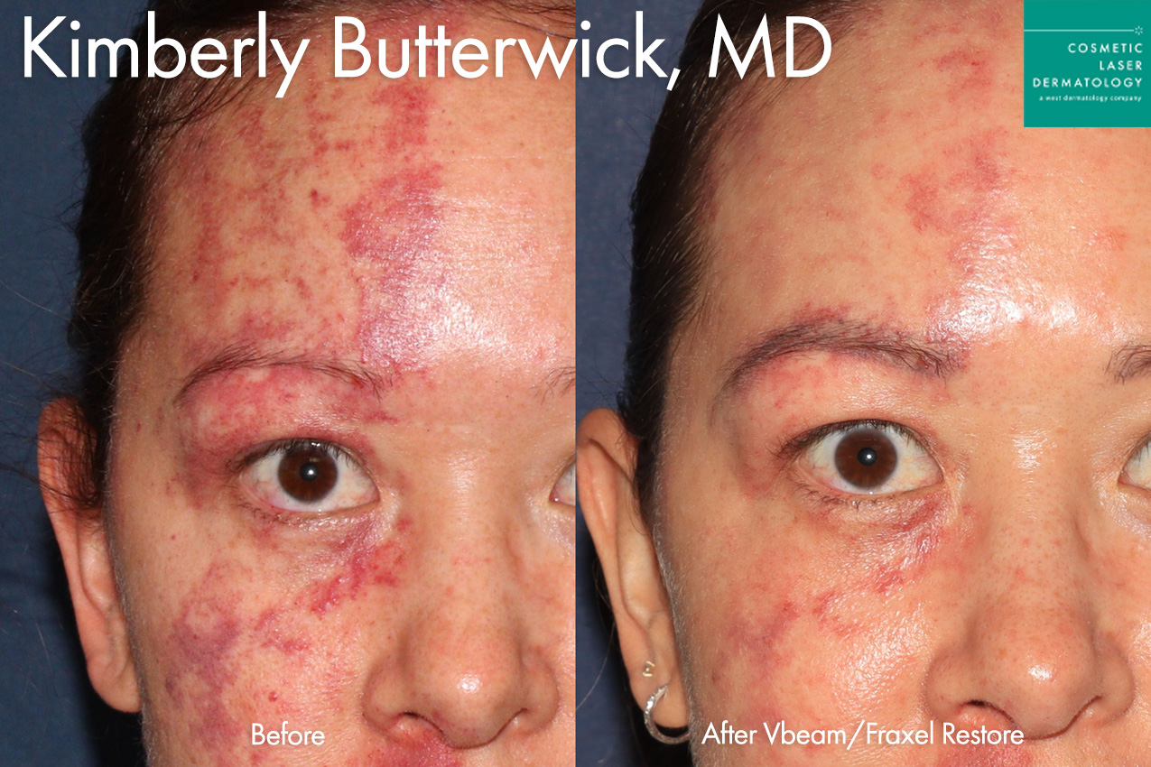 Vbeam and Fraxel Restore to treat port wine stain by Dr. Butterwick. After treatment, the patient's port wine stain has been significantly reduced.