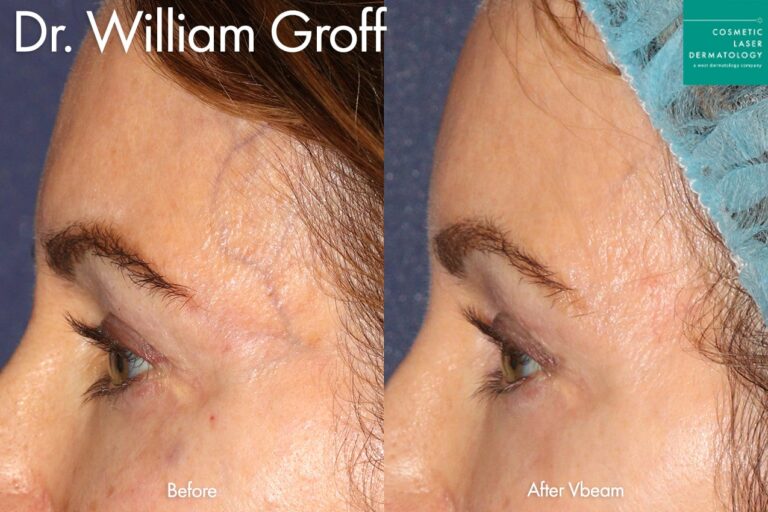 Vbeam to treat facial veins by Dr. Groff. After treatment, the patient's facial vein has disappeared.