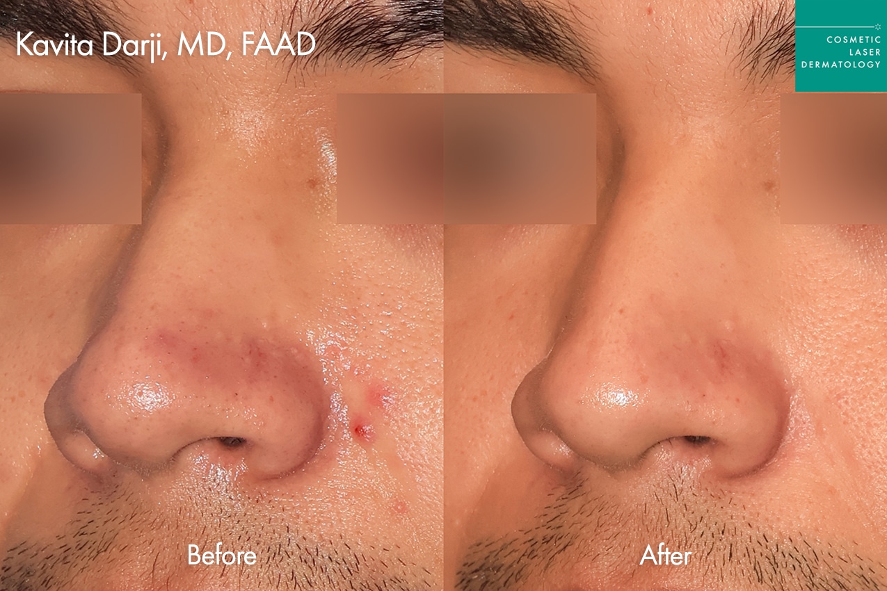 Accure for Acne treatment around nose