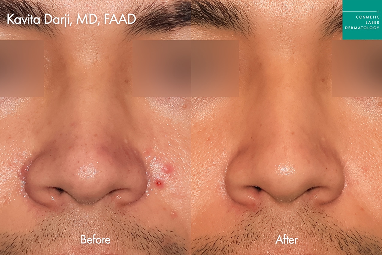 Accure for Acne treatment around nose