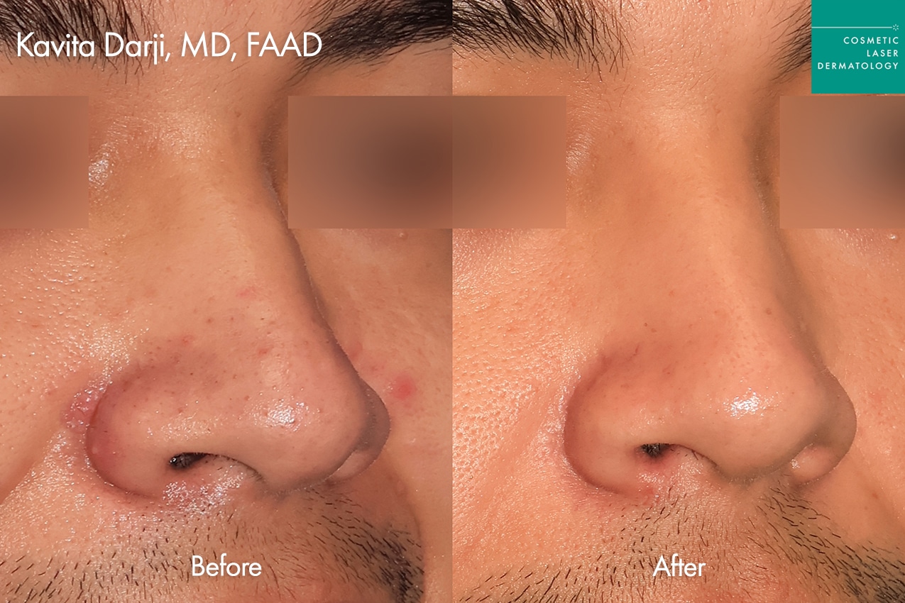 Accure for Acne treatment around nose
