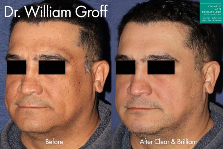 Clear + Brilliant to treat sun damage and rejuvenate the skin by Dr. Groff. After treatment skin is clearer and brighter.