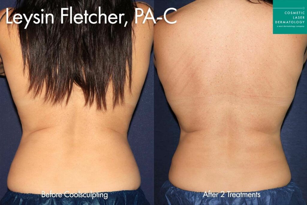 Cool Body Sculpting: Transforming Your Body Without Surgery - Cosmetic  Laser Dermatology Skin Specialists in San Diego