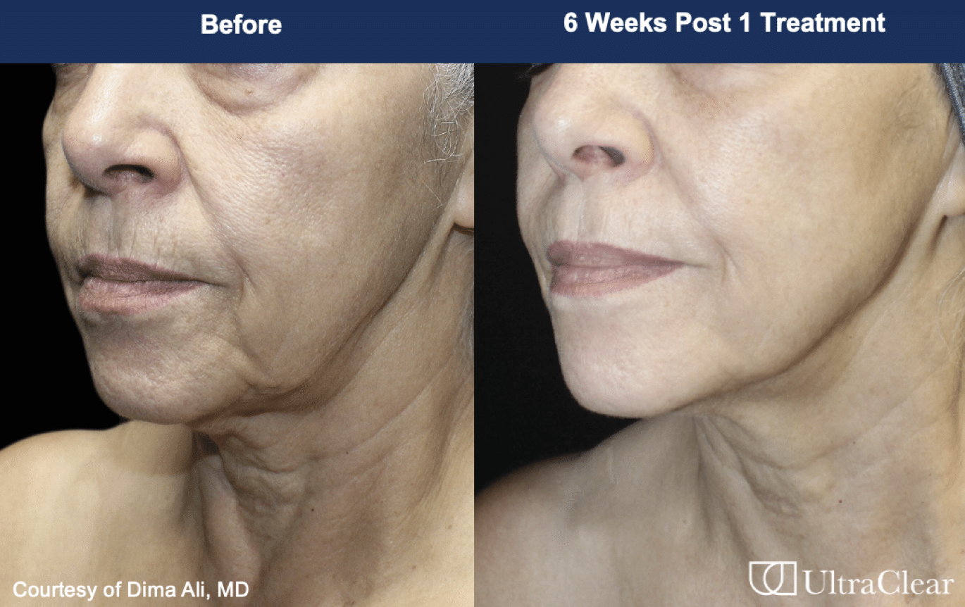 ultraclear laser treatment before and after