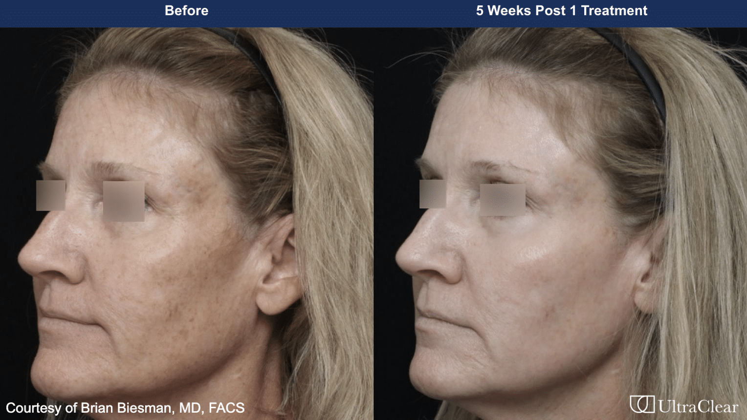 before and after image of woman for ultraclear laser