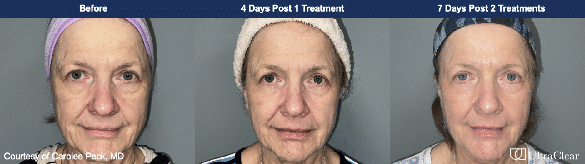 before and after images for ultraclear laser treatment