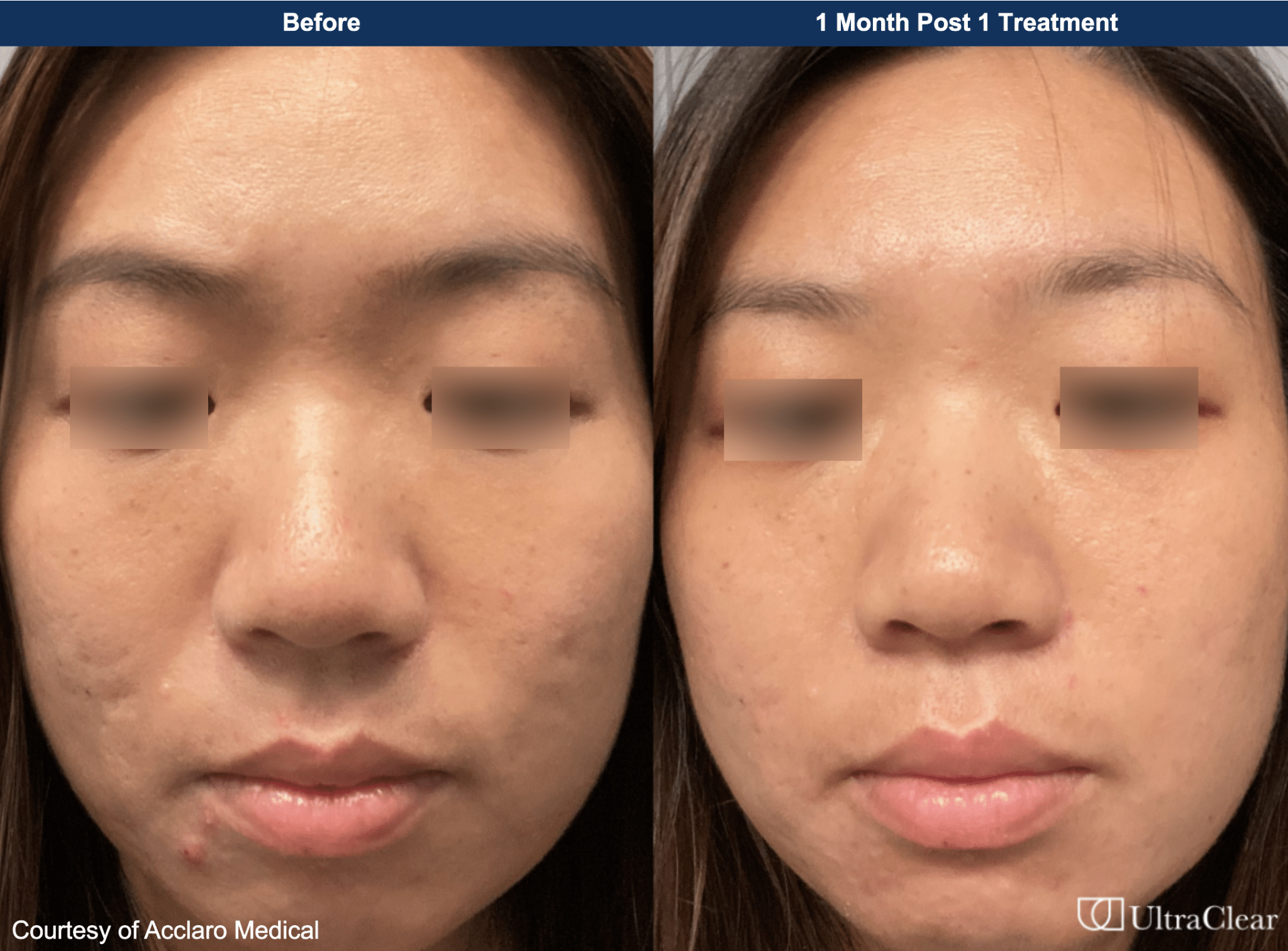 ultraclear laser befor and after