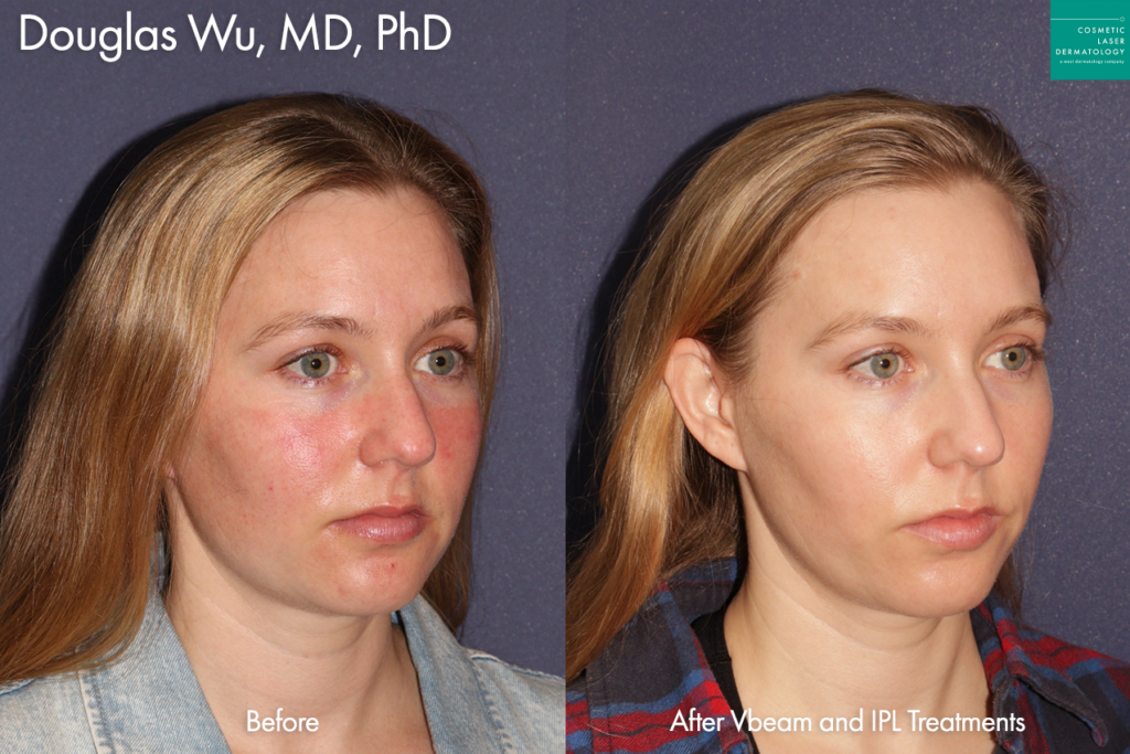 IPL and Vbeam to treat redness by Dr. Wu. Disclaimer: Results may vary from patient to patient. Results are not guaranteed.