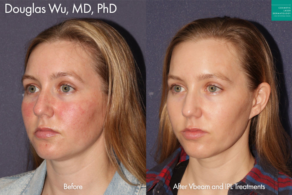 IPL and Vbeam to treat redness by Dr. Wu. Disclaimer: Results may vary from patient to patient. Results are not guaranteed.