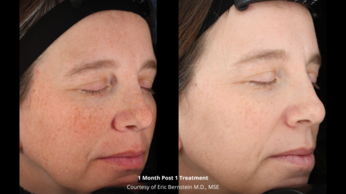 clderm ultraclear 1 month post 1 treatment san diego ca