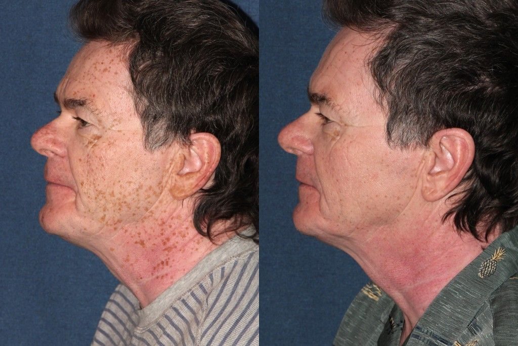 laser treatment results on a male patient