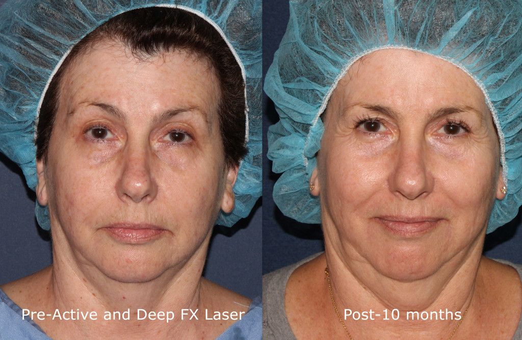 post 10 months after laser skin resurfacing