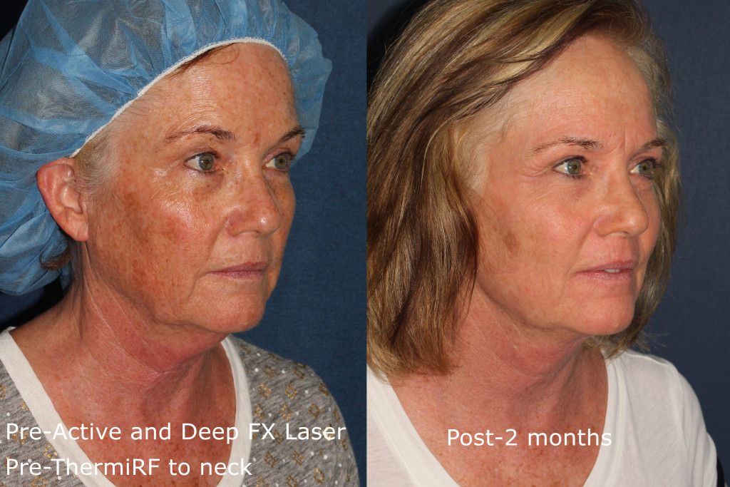 before and after lumenis treatment