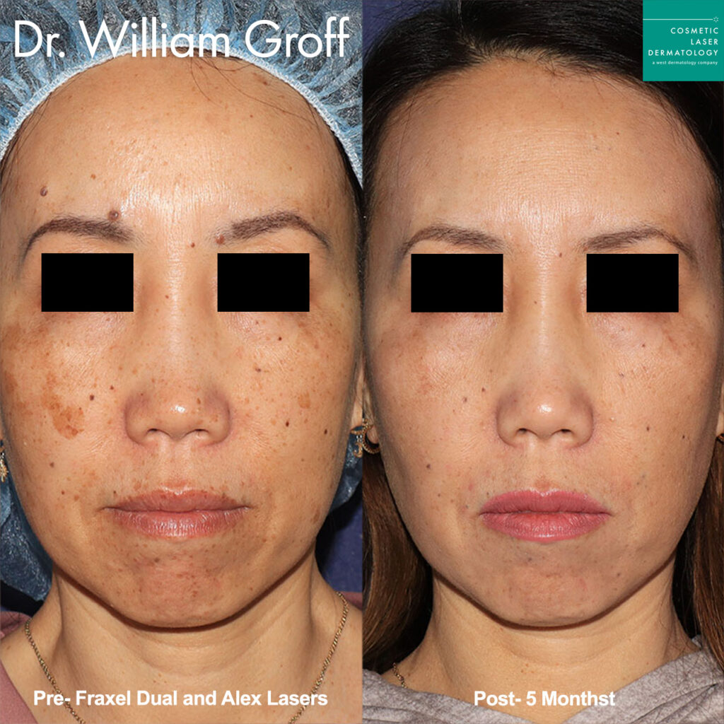 laser skin resurfacing results