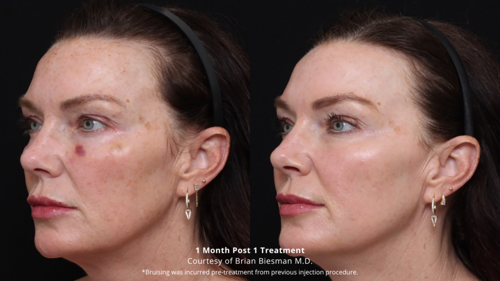 laser skin resurfacing before and after