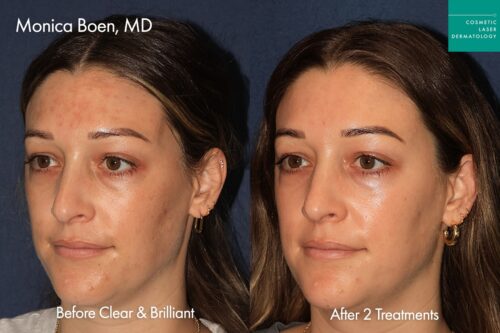 Female patient before and after Clear + Brilliant laser resurfacing in San Diego