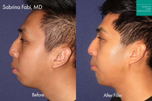 Male patient before and after chin and jawline contouring in San Diego