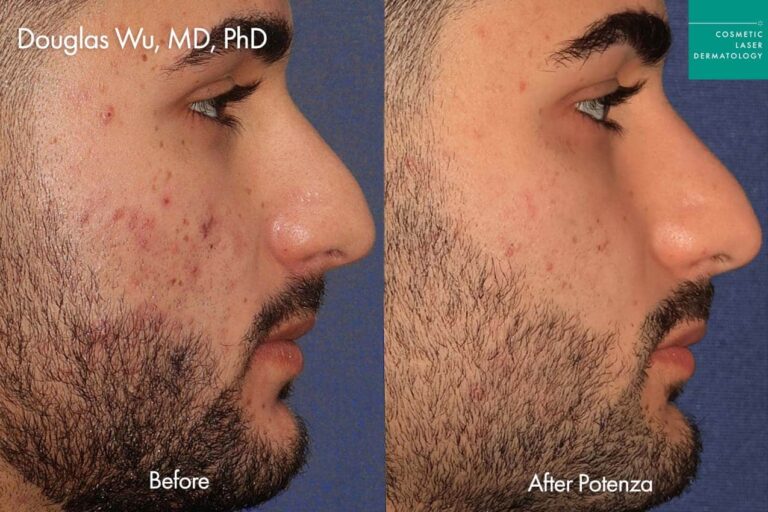 ide profile before and after Potenza RF Microneedling treatment, showing reduced acne scars and smoother skin texture.