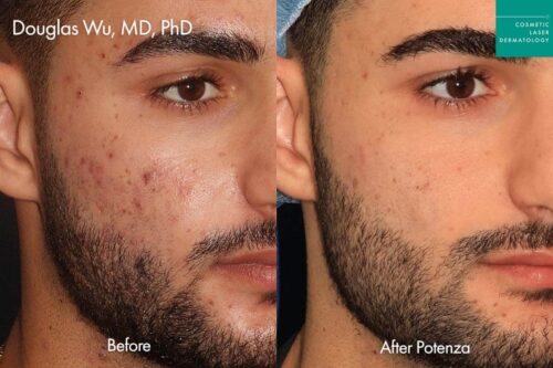 Male acne treatment results before and after laser resurfacing in San Diego