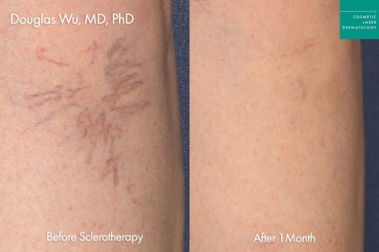 sclerotherapy treatment for legs before and after clderm san diego