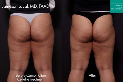 Sculptra treatment female before and after clderm san diego