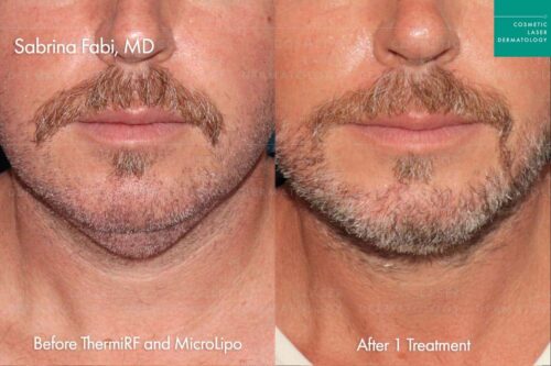 Male patient neck results following thermi and microlipo in san diego