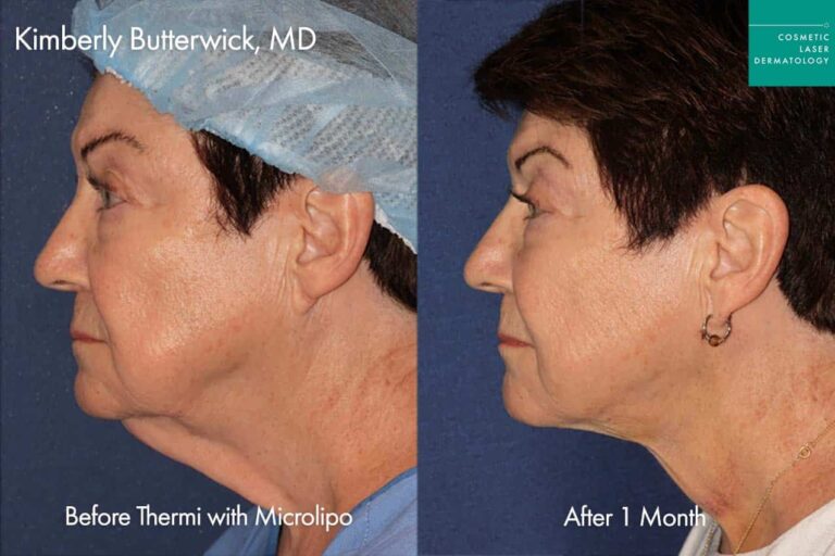 Thermi treatment San Diego CA.