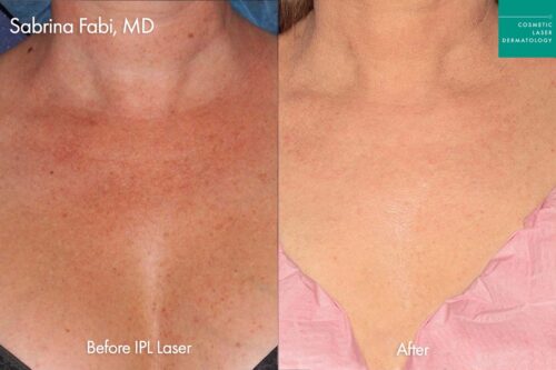 Chest Rejuvenation before and after photos following laser treatment in San Diego