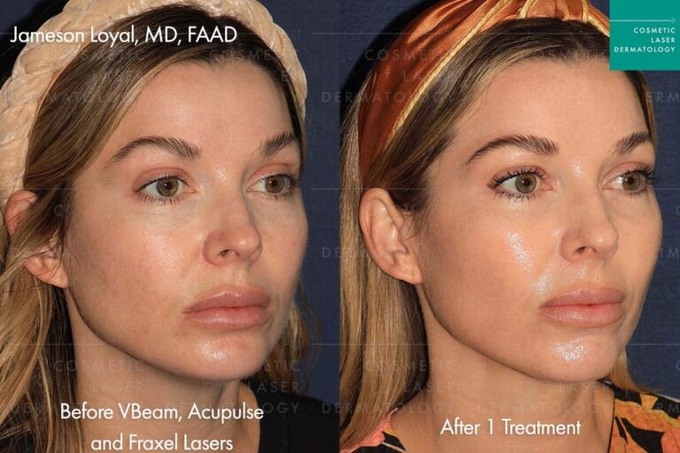 vbeam prima acupulse treatment to treat female face before and after photo clderm san diego