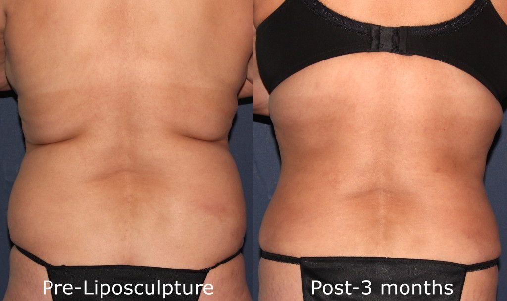 before and after liposculpture in san diego