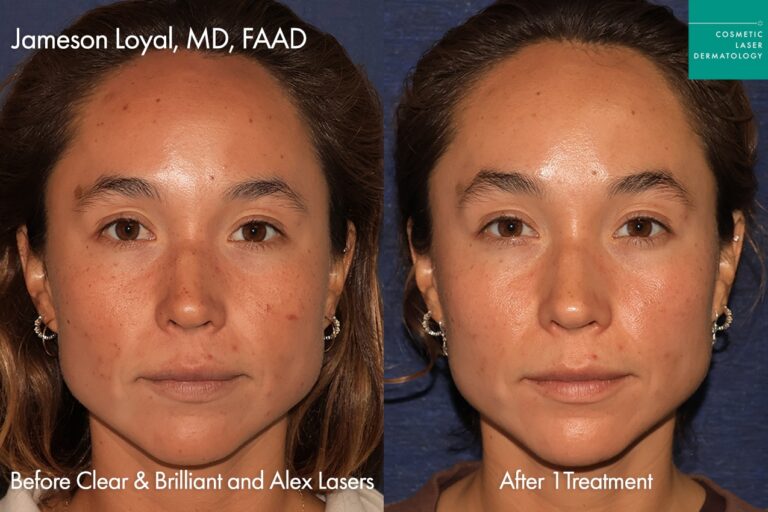 Before and after comparison of Clear & Brilliant laser treatment, highlighting enhanced skin tone, brightness, and elasticity.
