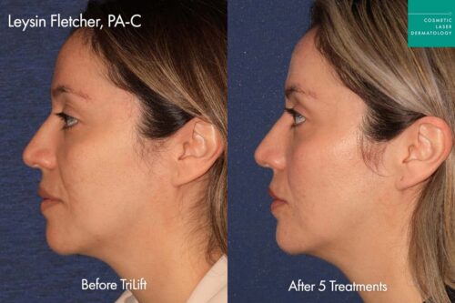 Trilift Before and after photos of a female patient performed by Dr. Leysin at Cosmetic Laser Dermatology (CLDerm) in San Diego