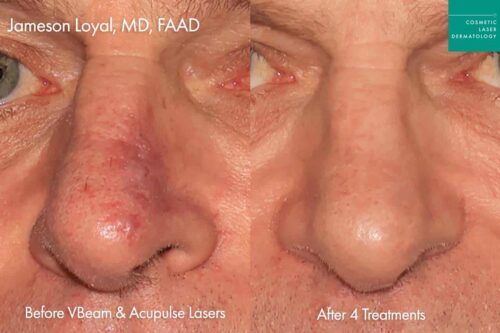 Male patient comparison results before and after treatment with Vbeam in San Diego for redness of the nose.