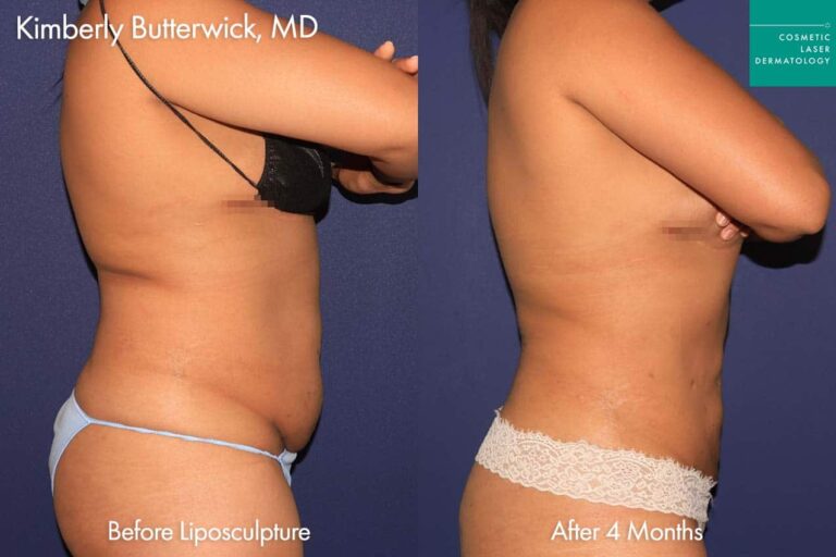 liposculpture body contouring results