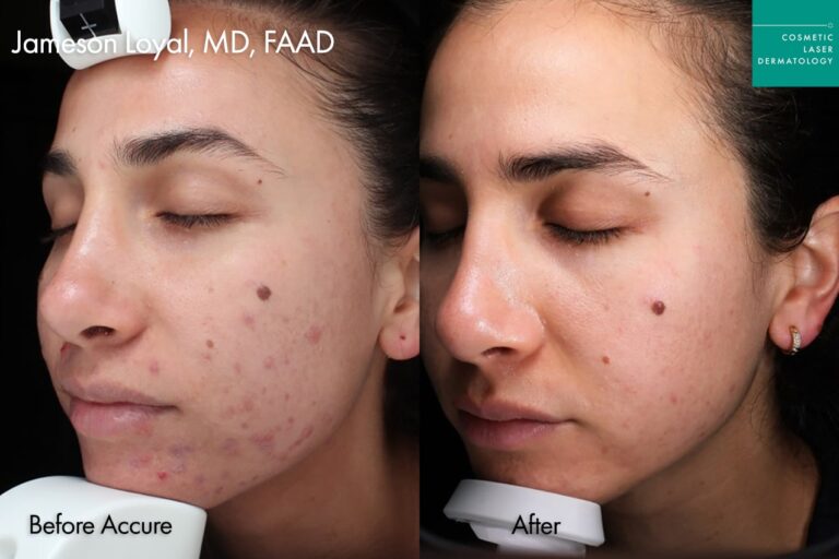 Before and after results of Accure Laser treatment for acne, showing smoother skin, reduced breakouts, and improved skin texture,