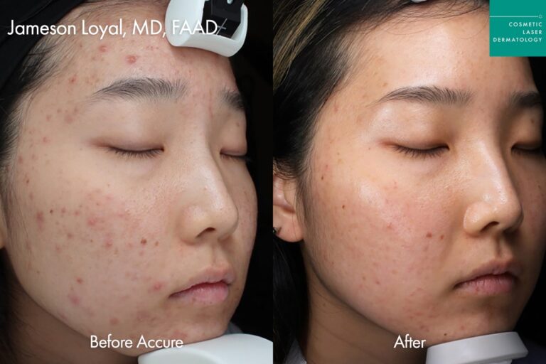 acne treatment with accure