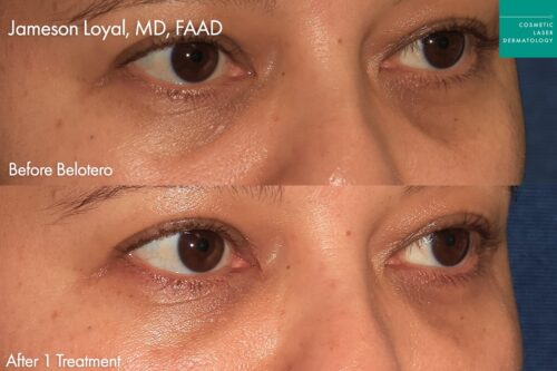 Patient results before and after belotero filler in San Diego