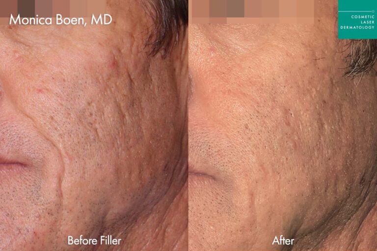 Web Filler AcneScars Treatment San Diego