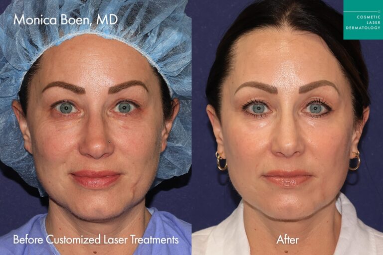 fraxel co2 laser, before and after the procedure