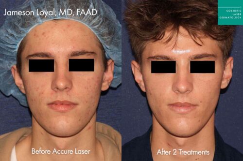Young male patient before and after laser acne treatment in San Diego