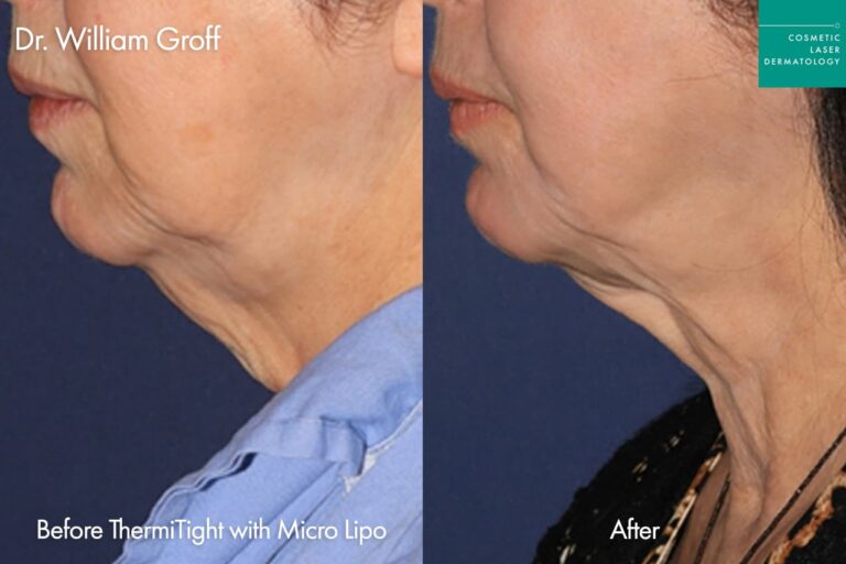 Before and after side image of Thermi Neck contouring performed by Dr. Groff at our San Diego medical clinic CL Derm