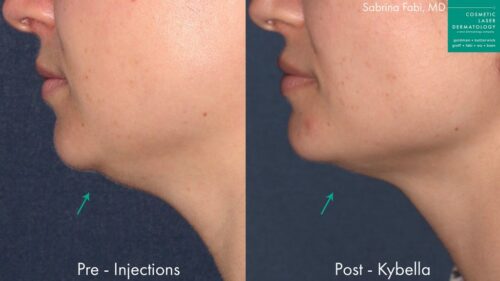 kybella treatment for double chin female before and after clderm san diego